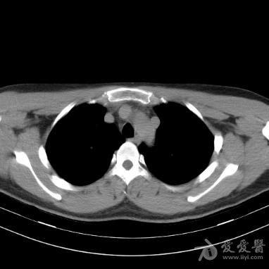 永存左上腔静脉.