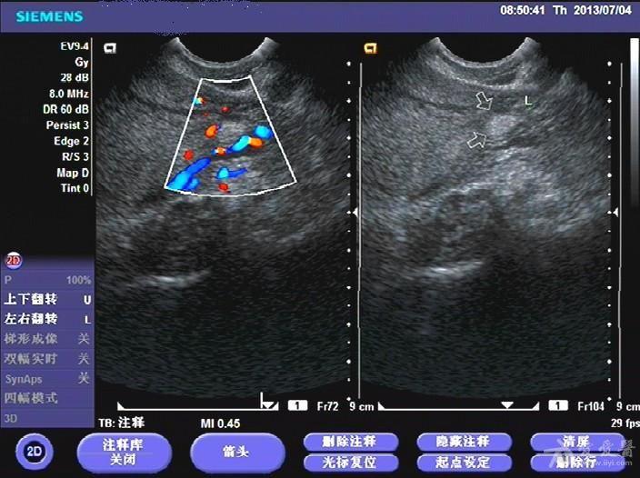 子宫血管瘤?
