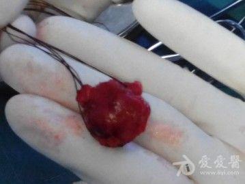 发现右颈部肿块1年