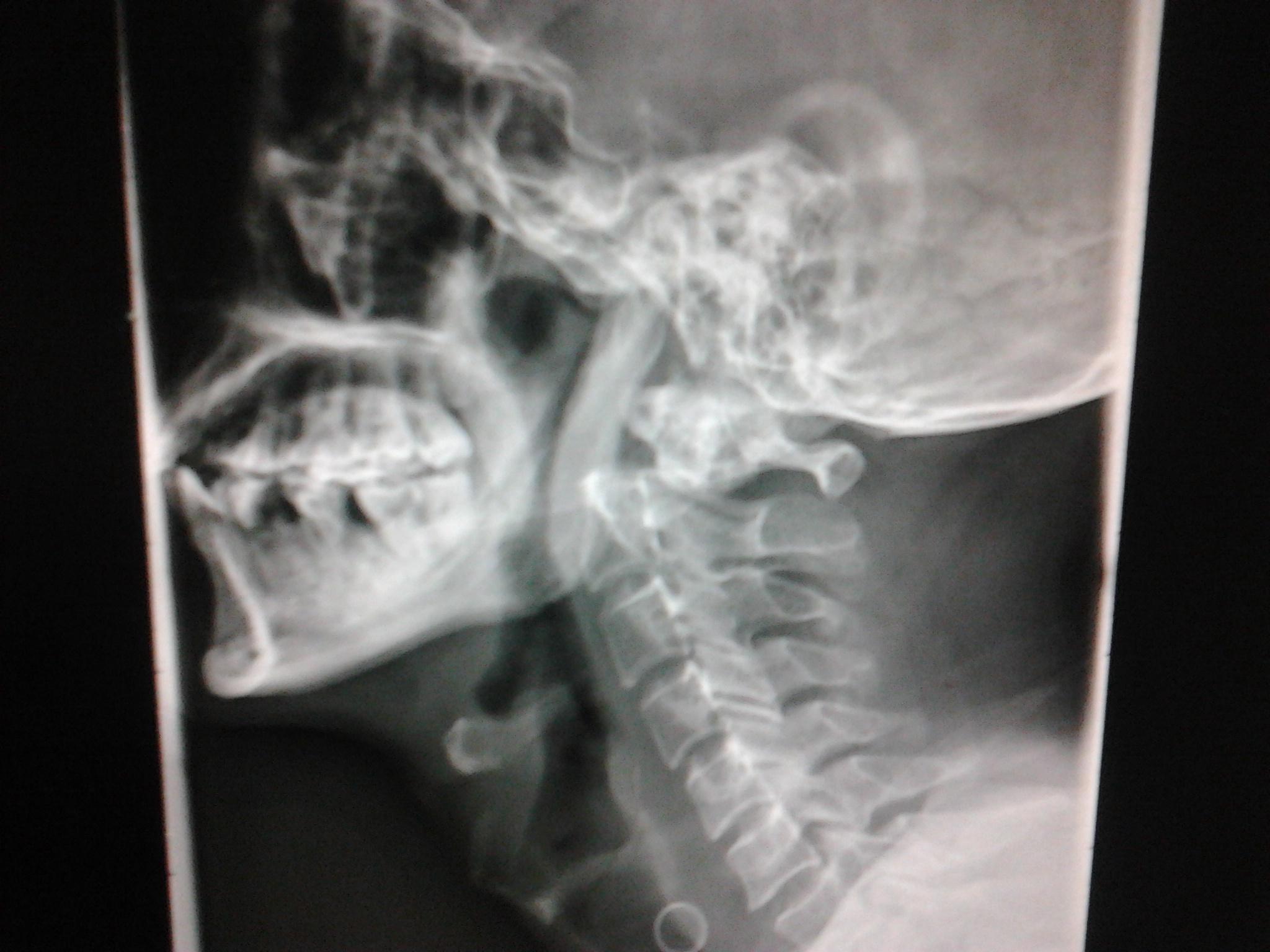 齿状突骨折