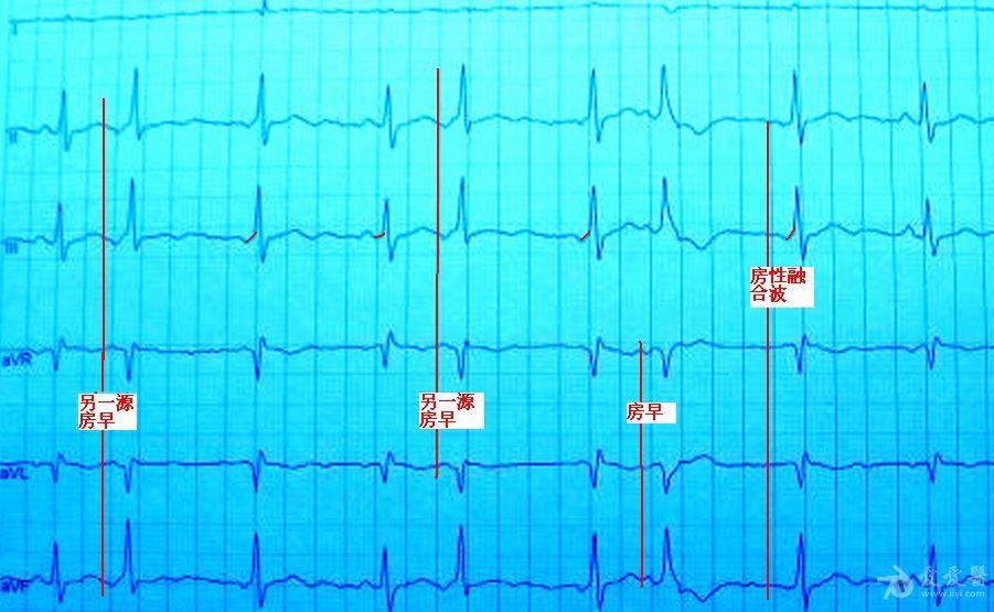 有p波的"室早",谁见过? - 心电图脑电图专业讨论版