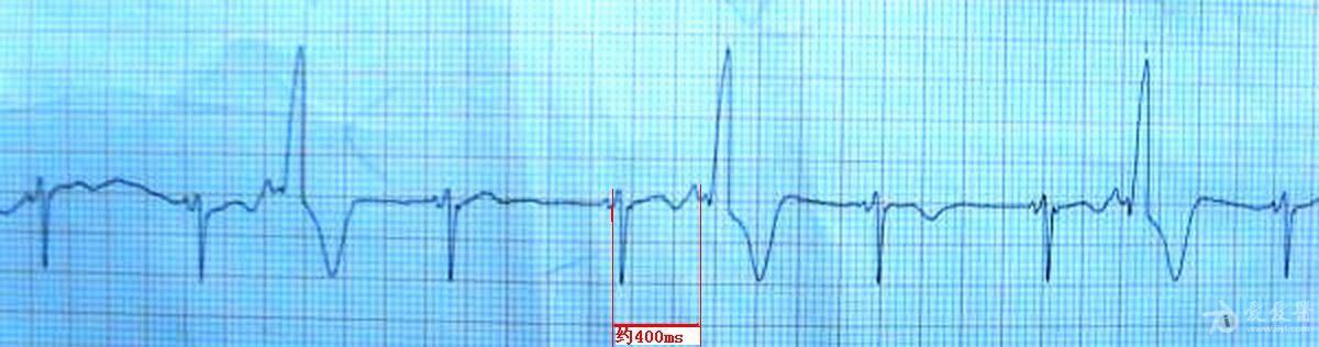 有p波的"室早,谁见过 心电图脑电图专业讨论版 爱爱医医学论坛