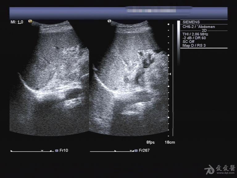 半夜来的脾破裂 - 超声医学讨论版 - 爱爱医医学论坛