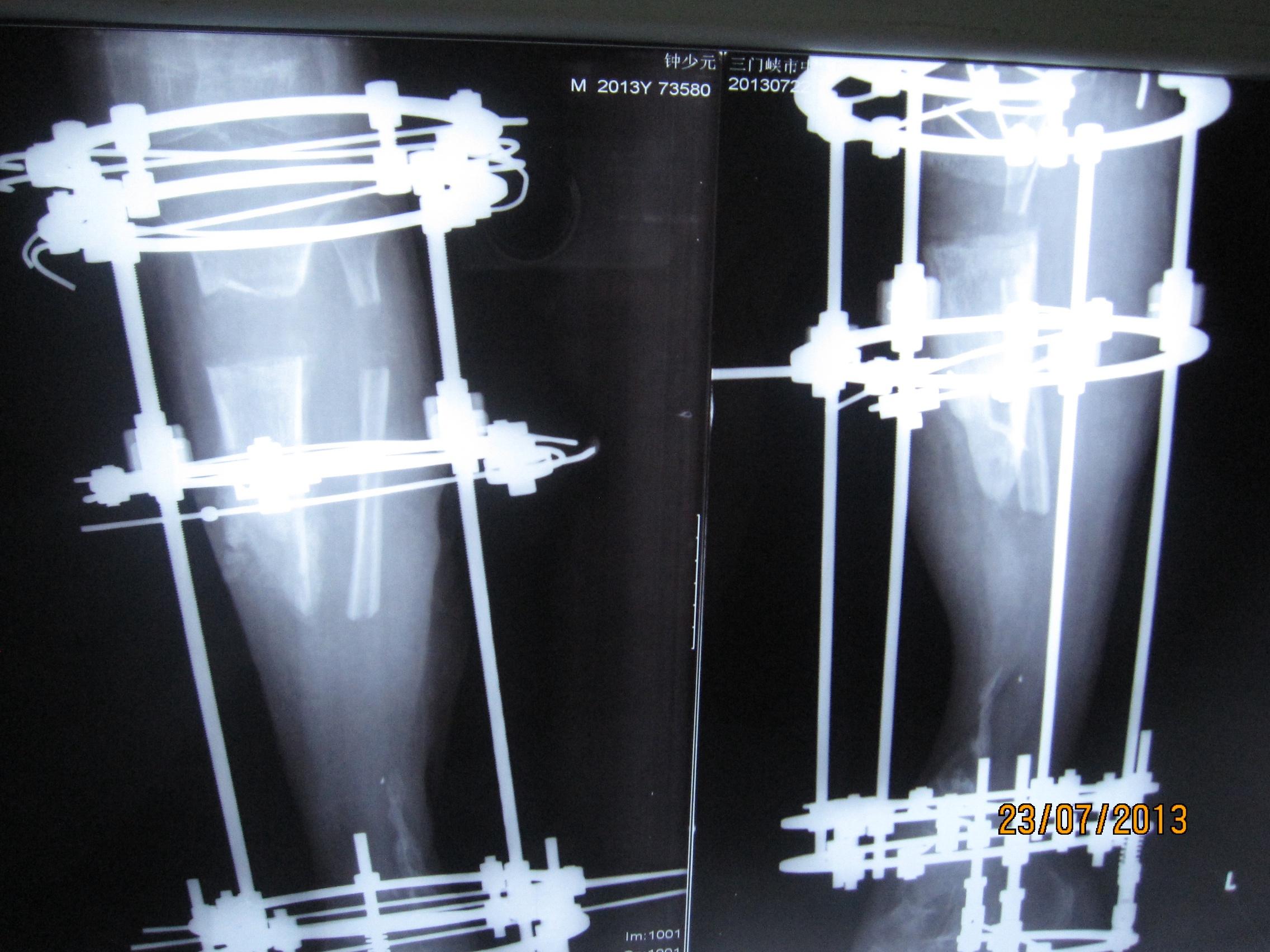 左胫腓骨长段骨缺损行ilizarov外固定架 骨科与显微外科专业讨论版