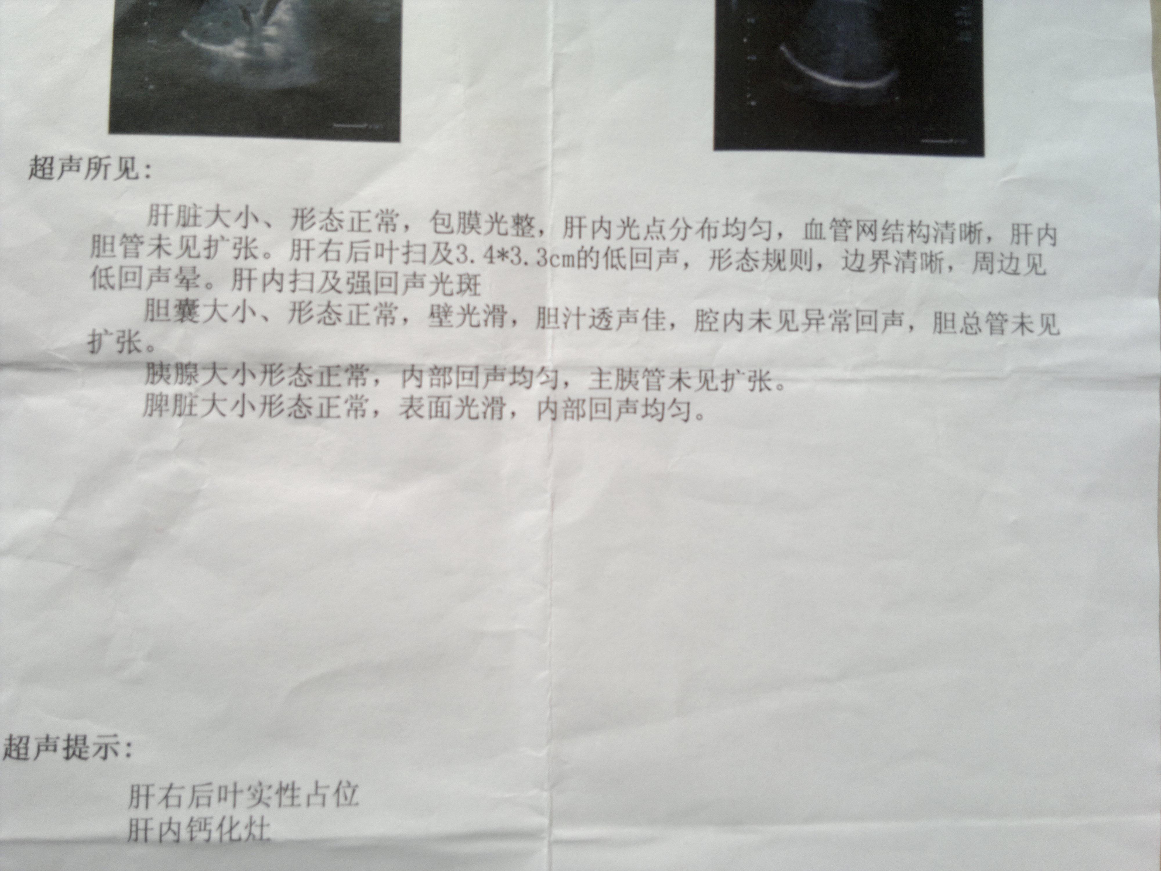 请问各位大神,这个是恶性肿瘤吗?