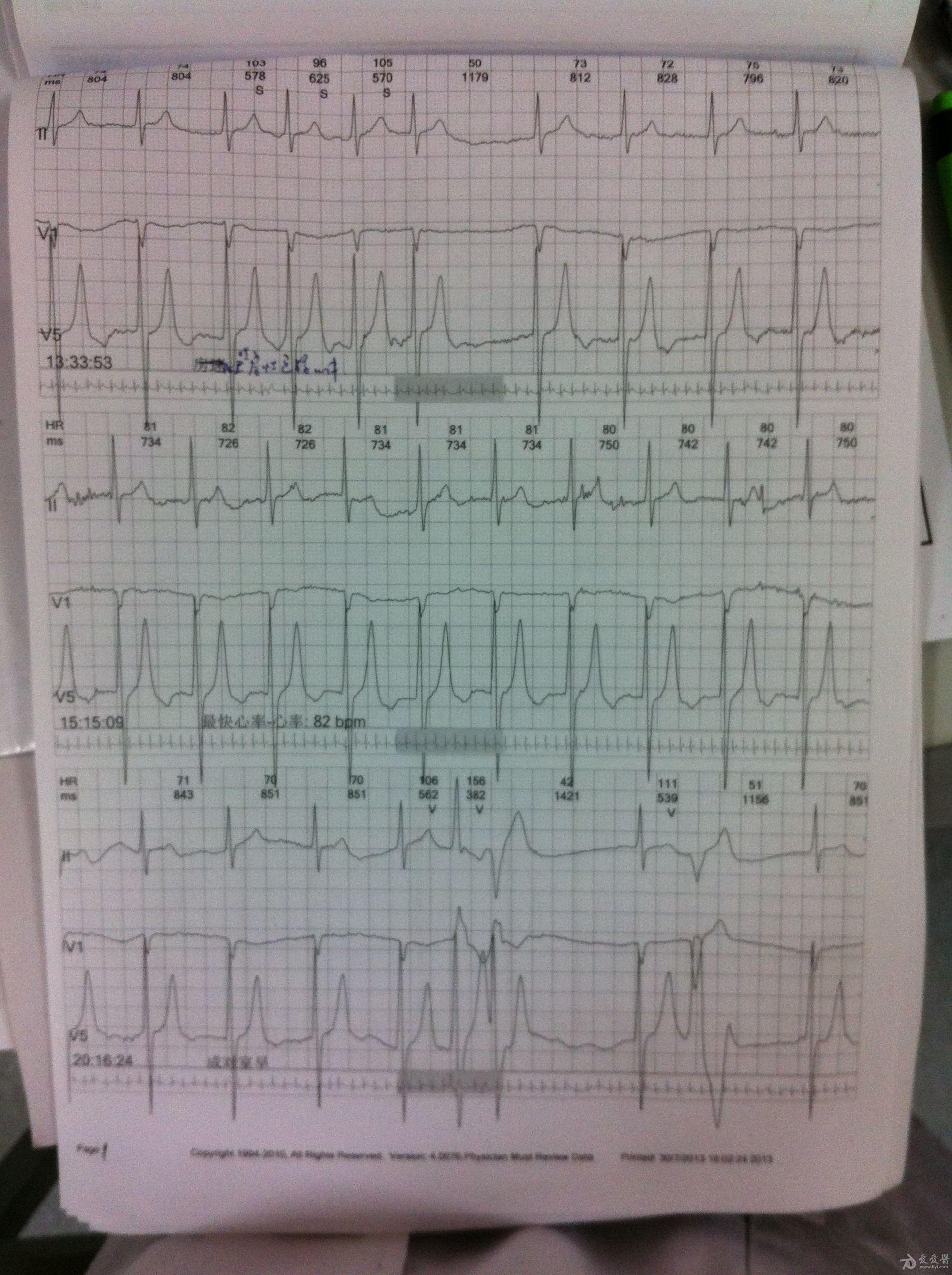 请老师们看看,房颤还是加速{banned}界性逸搏心律