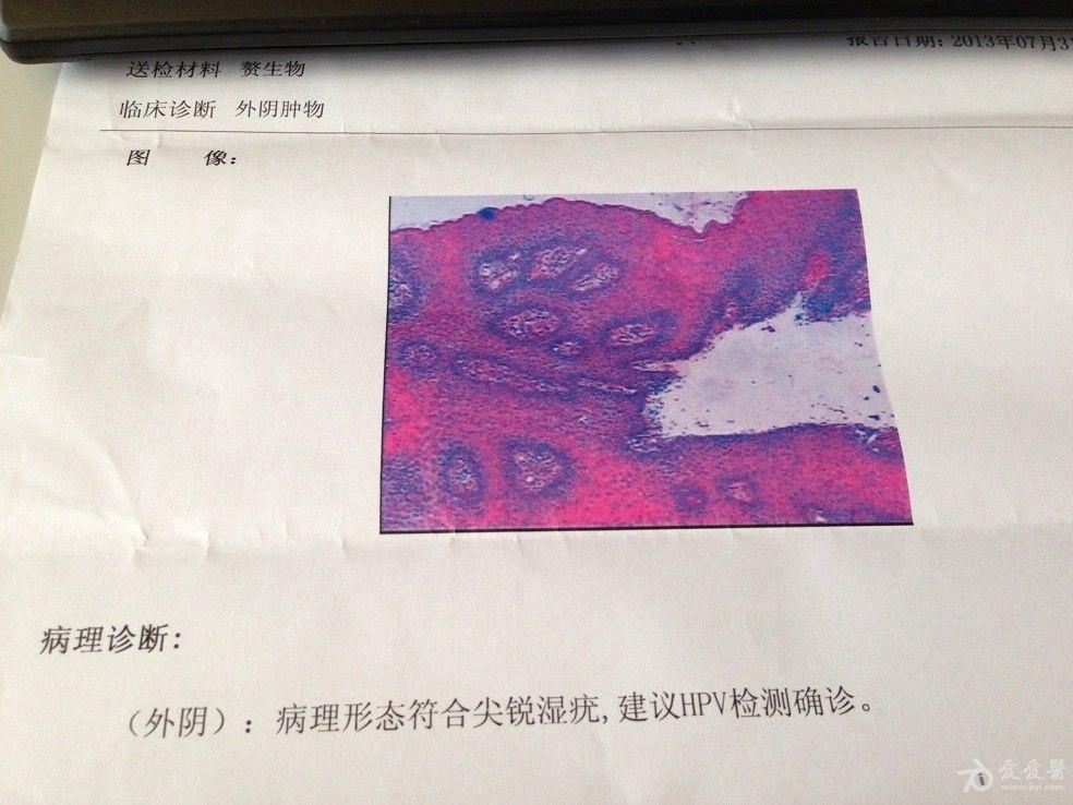 帮我看看这个报告,尖锐湿疣吗?最新取回hpv检测报告