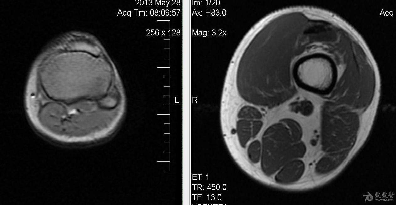 左膝的核磁共振图像大侠帮忙看看