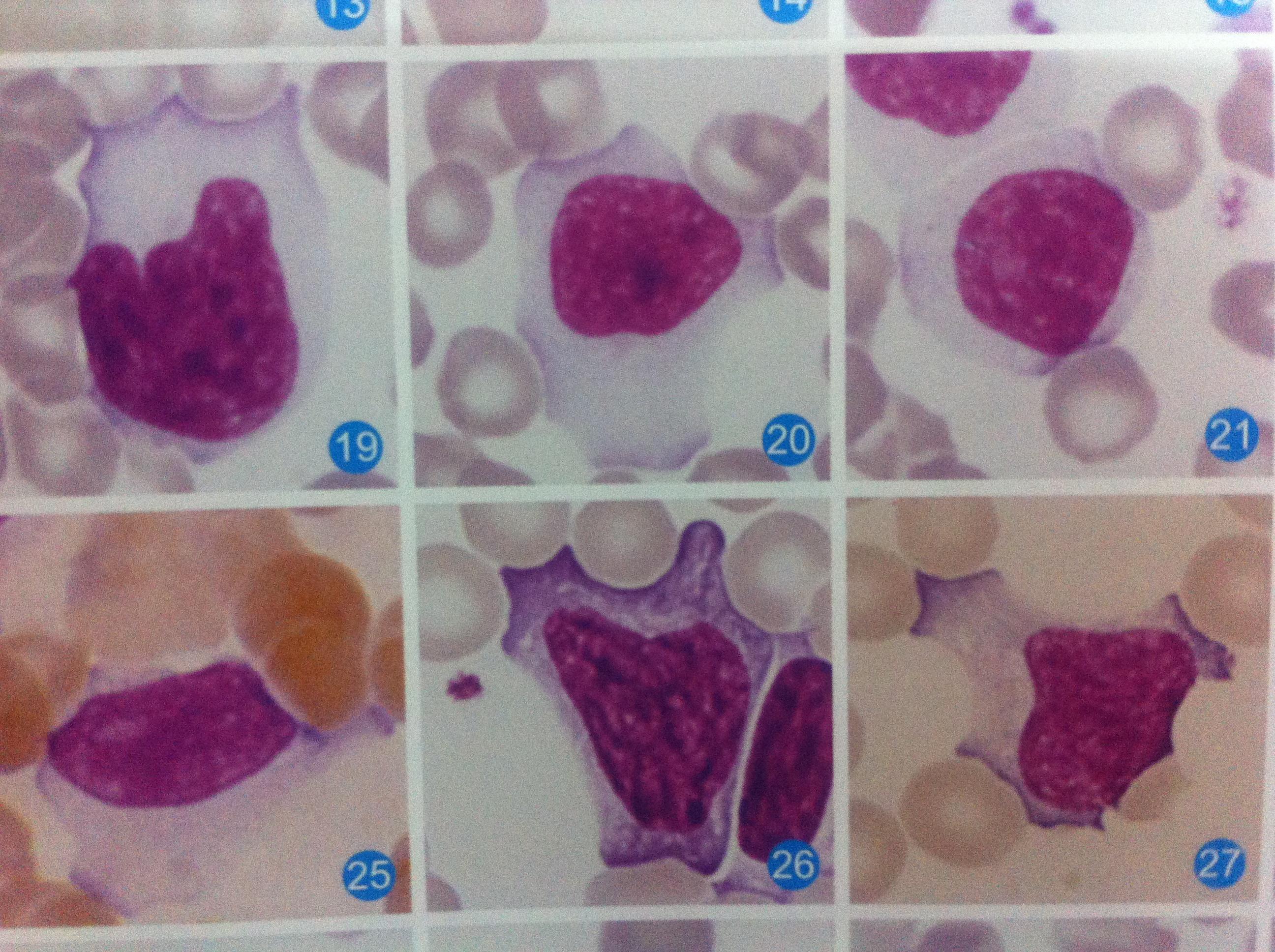 求异型淋巴细胞三种类型的多组图片及解析