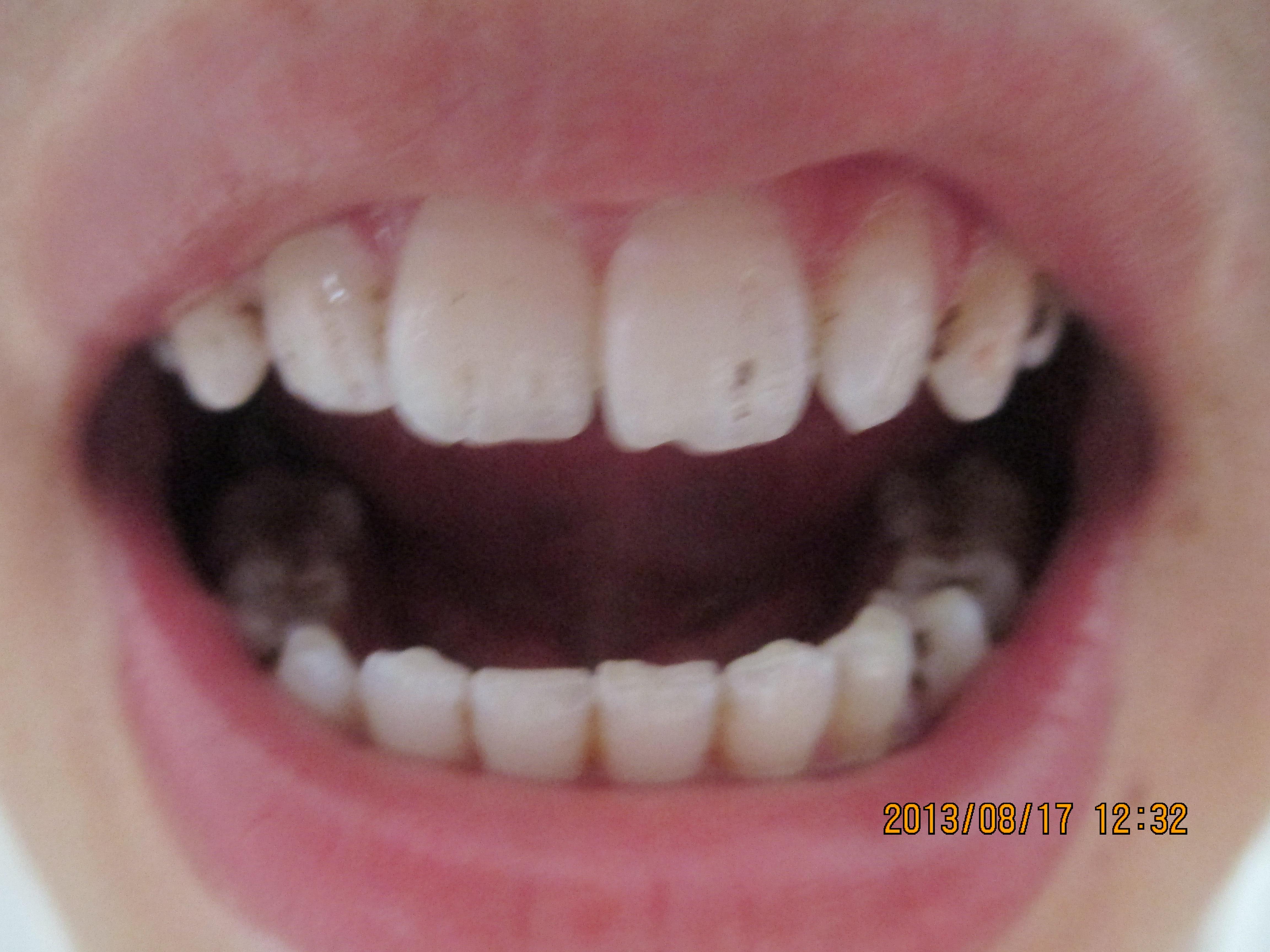 注册x  我老婆牙质从一年前无明显原因开始变黑,现在越来越重,并且我