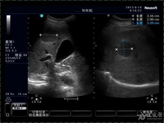 肝血管瘤 超声医学讨论版 爱爱医医学论坛