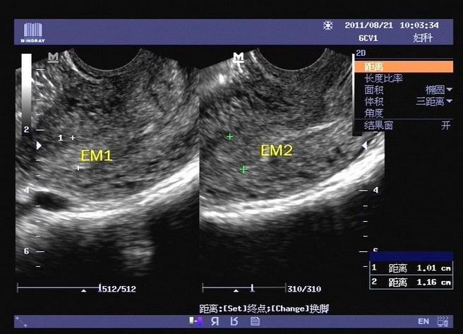 不全纵隔子宫早孕期与非孕期的超声图