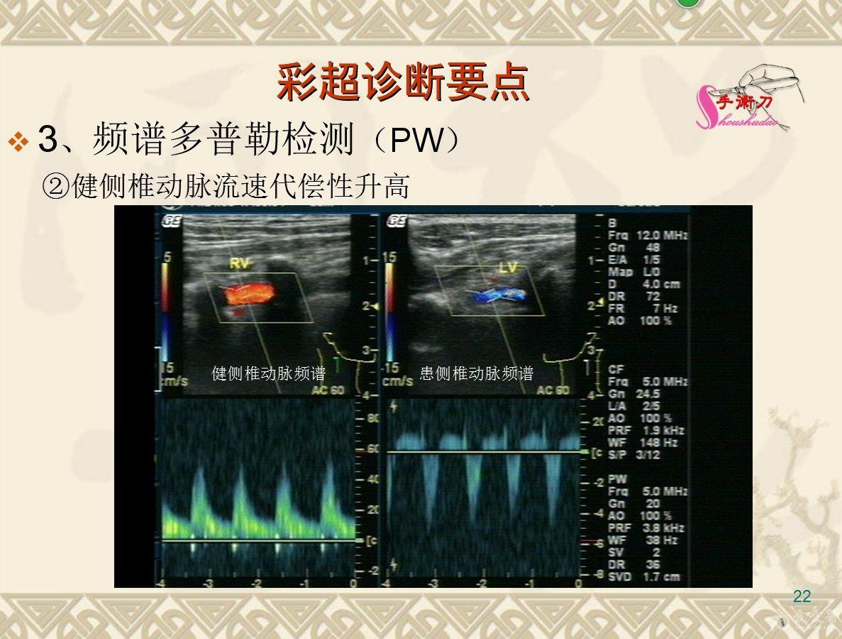锁骨下动脉窃血综合征超声诊断图解