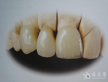 各种义齿的介绍