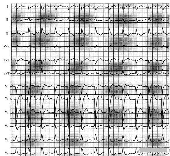 卢喜烈教你分析心电图:房性心动过速系列病例