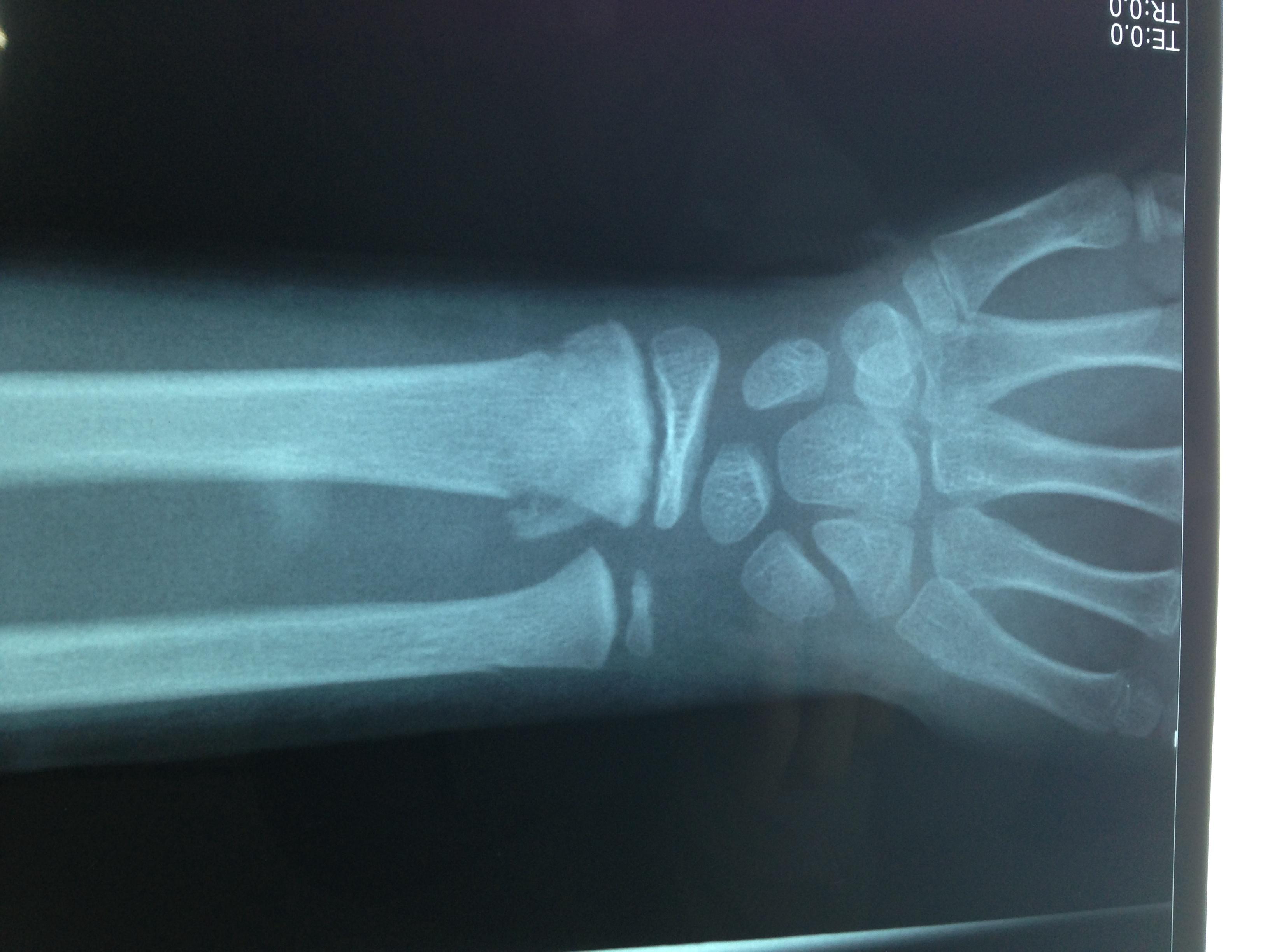 请大家看看张x光片桡骨远端骨折复位前后