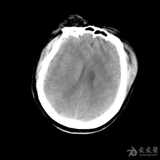 颞窝硬膜外血肿开不开何时开
