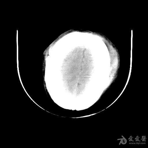 颞窝硬膜外血肿开不开何时开