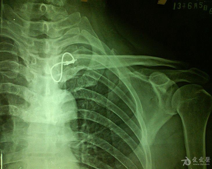 胸锁关节骨折脱位钢缆固定.