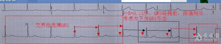房室分离和3度房室传导阻滞的鉴别 - 心电图脑电图版