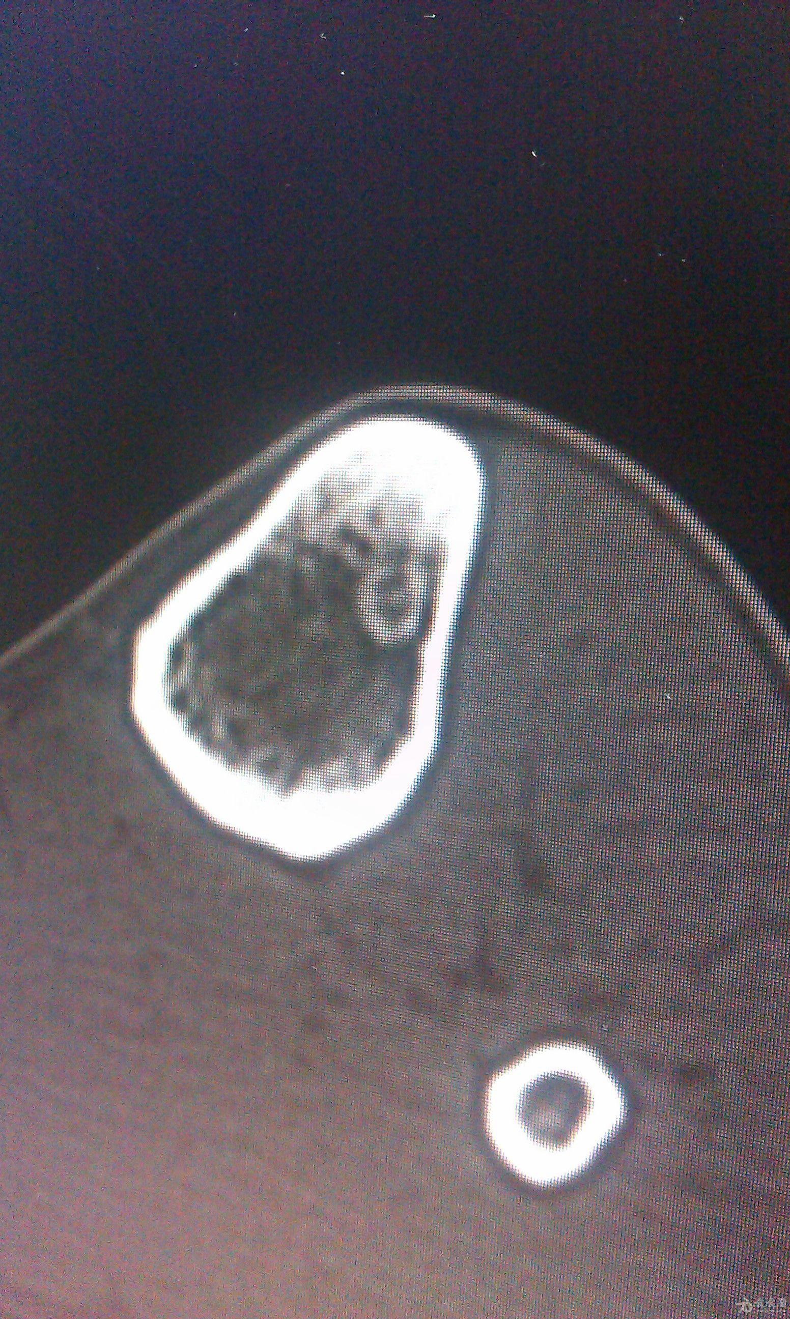 肾上长肿瘤是恶性的吗_肿瘤信号是长t1长t2_耳朵后面长了个硬包是肿瘤吗？