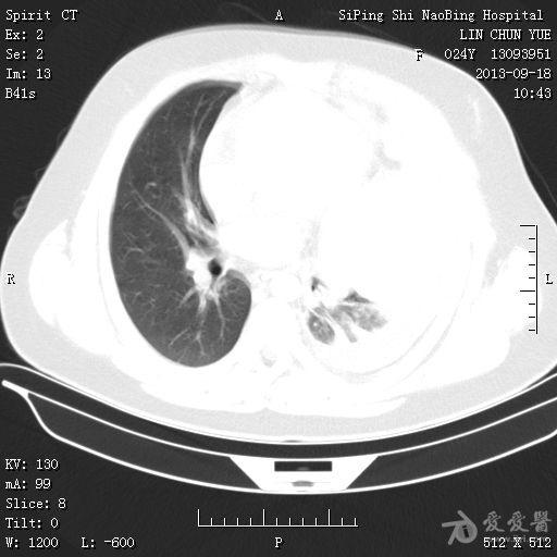 一个年轻患者的肺ct