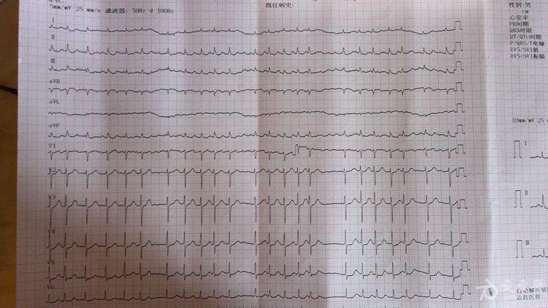 房扑?还是房颤? - 心电图脑电图专业讨论版 - 爱爱医医学论坛