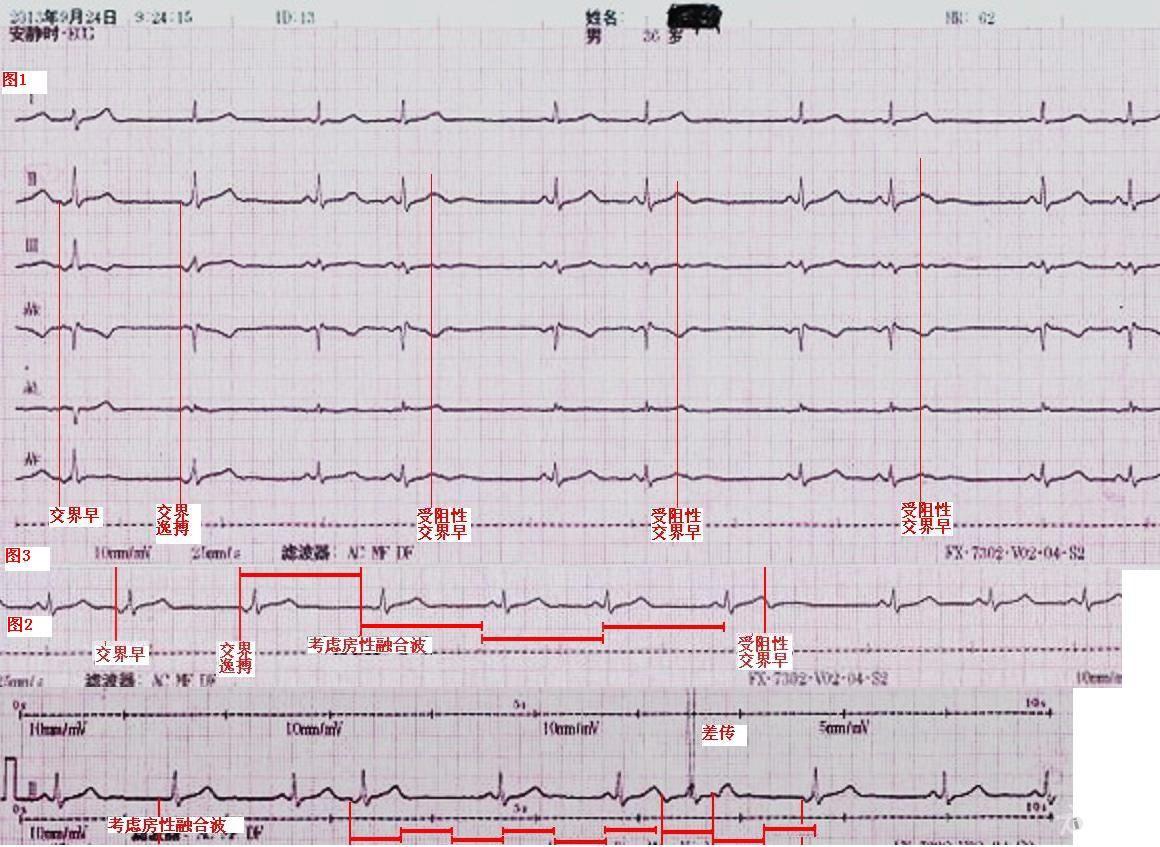交界性早搏伴部分未下传,交界性逸搏 心电图脑