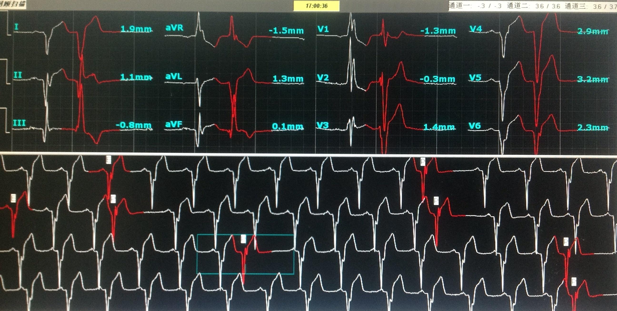 动态心电图三通道请老师帮我分析下