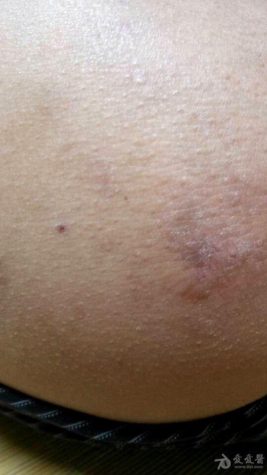 请问这个是什么皮肤病啊?