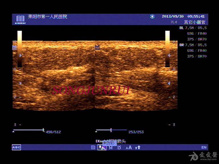 超声入门贴162肩部脂肪瘤体表图超声图