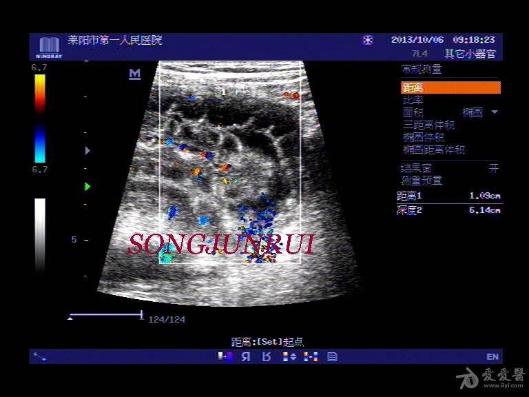 超声入门贴168阑尾穿孔超声图术后标本