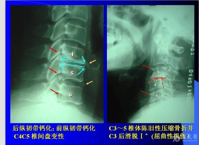 颈椎病x片阅读指南
