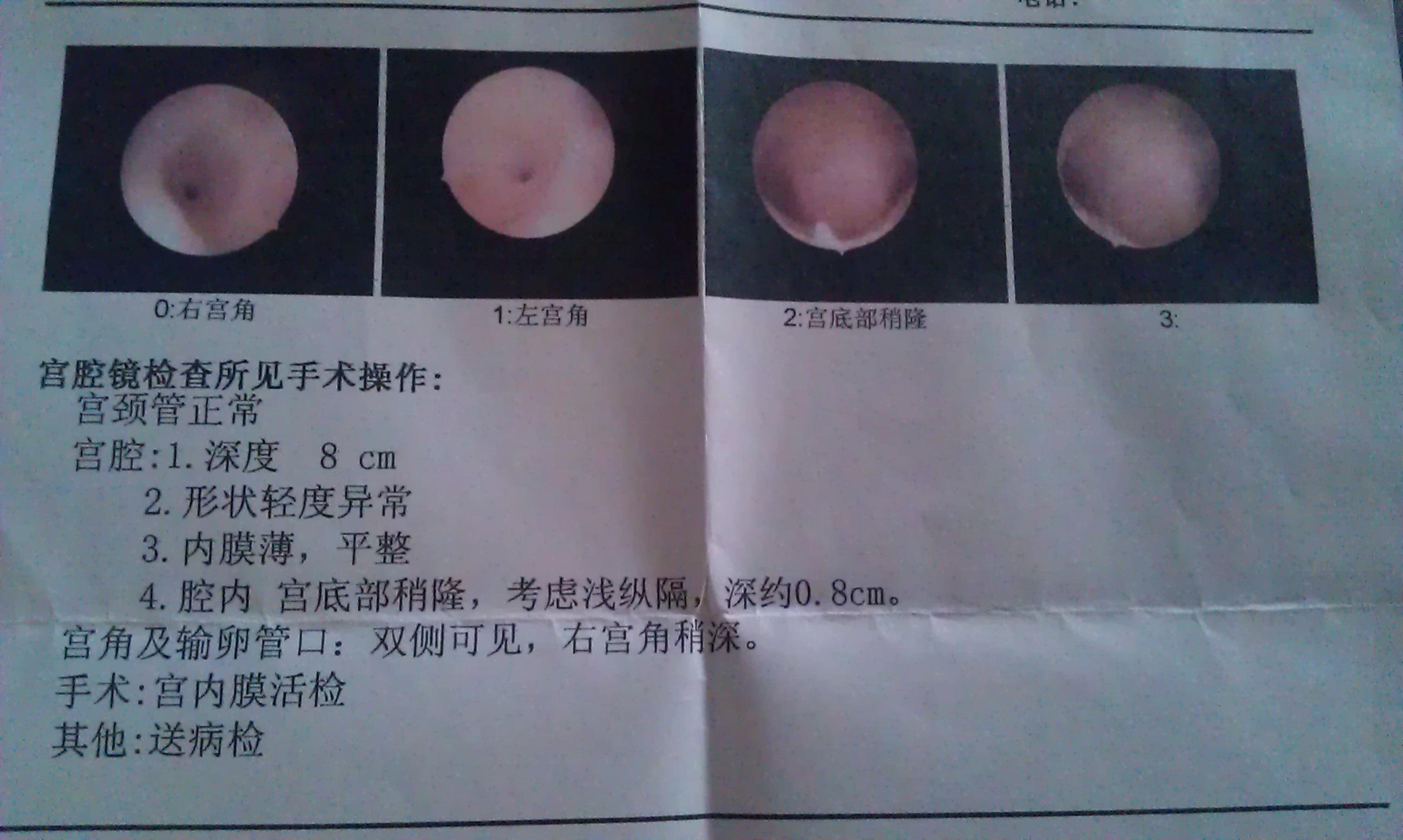 宫腔镜下提示子宫浅纵膈是否要手术呢