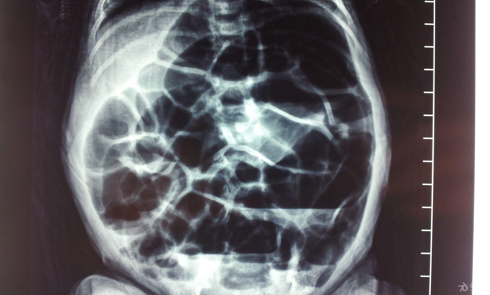 腹部平片提示如下.后确诊为先天性巨结肠,手术后痊愈.