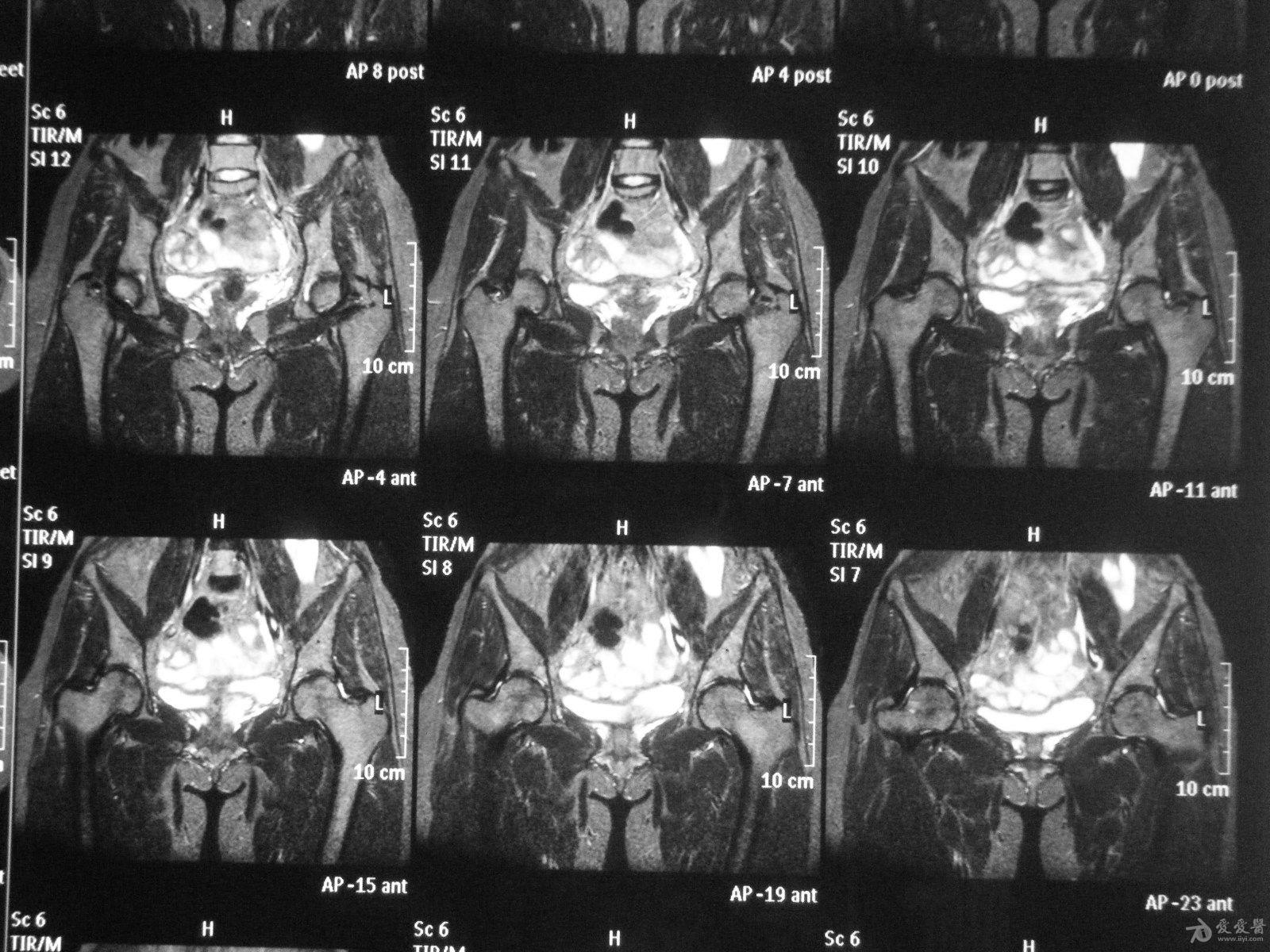 髋关节mri