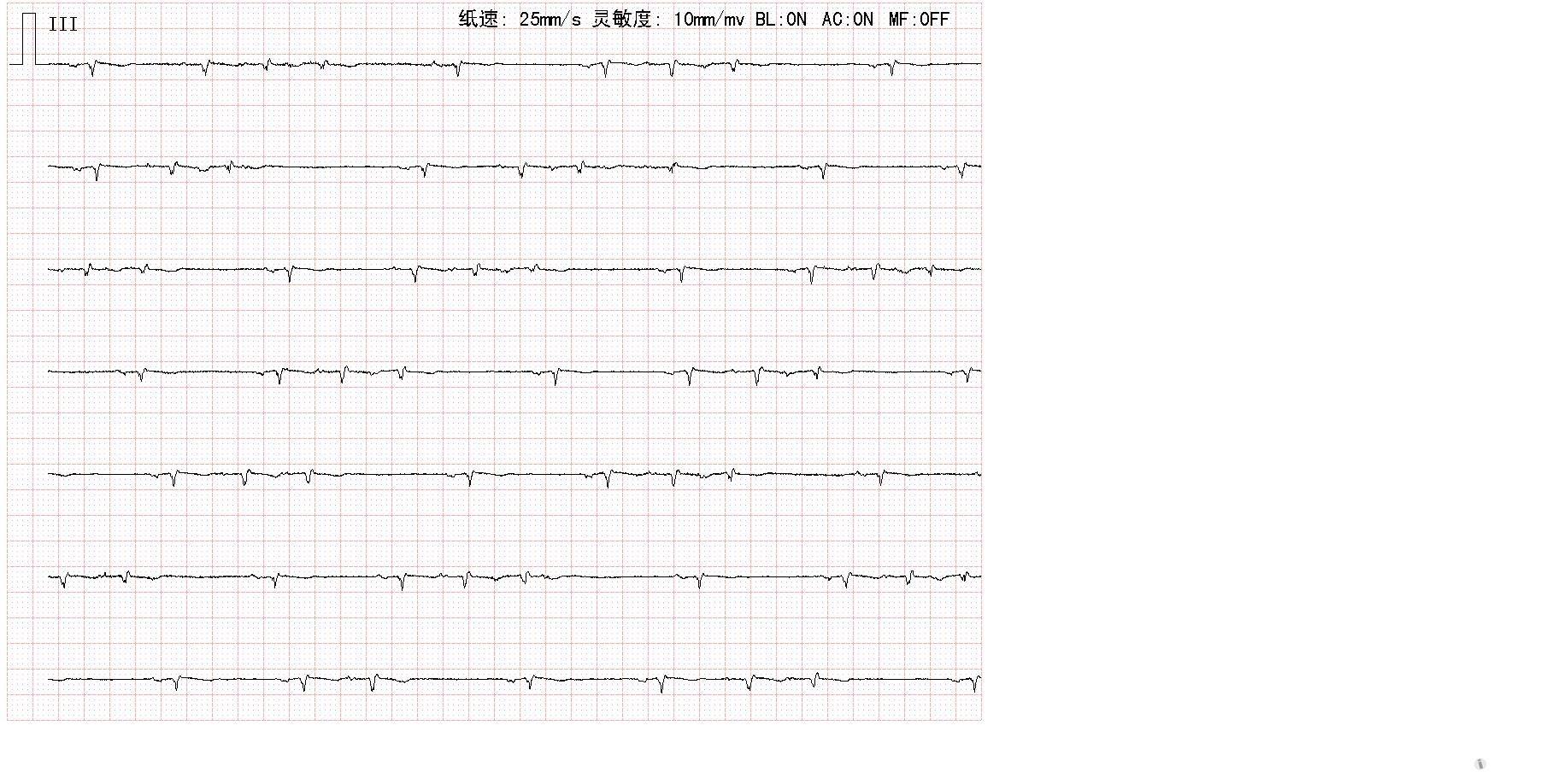 大家帮忙看看这份心电图 - 心电图脑电图专业讨论版