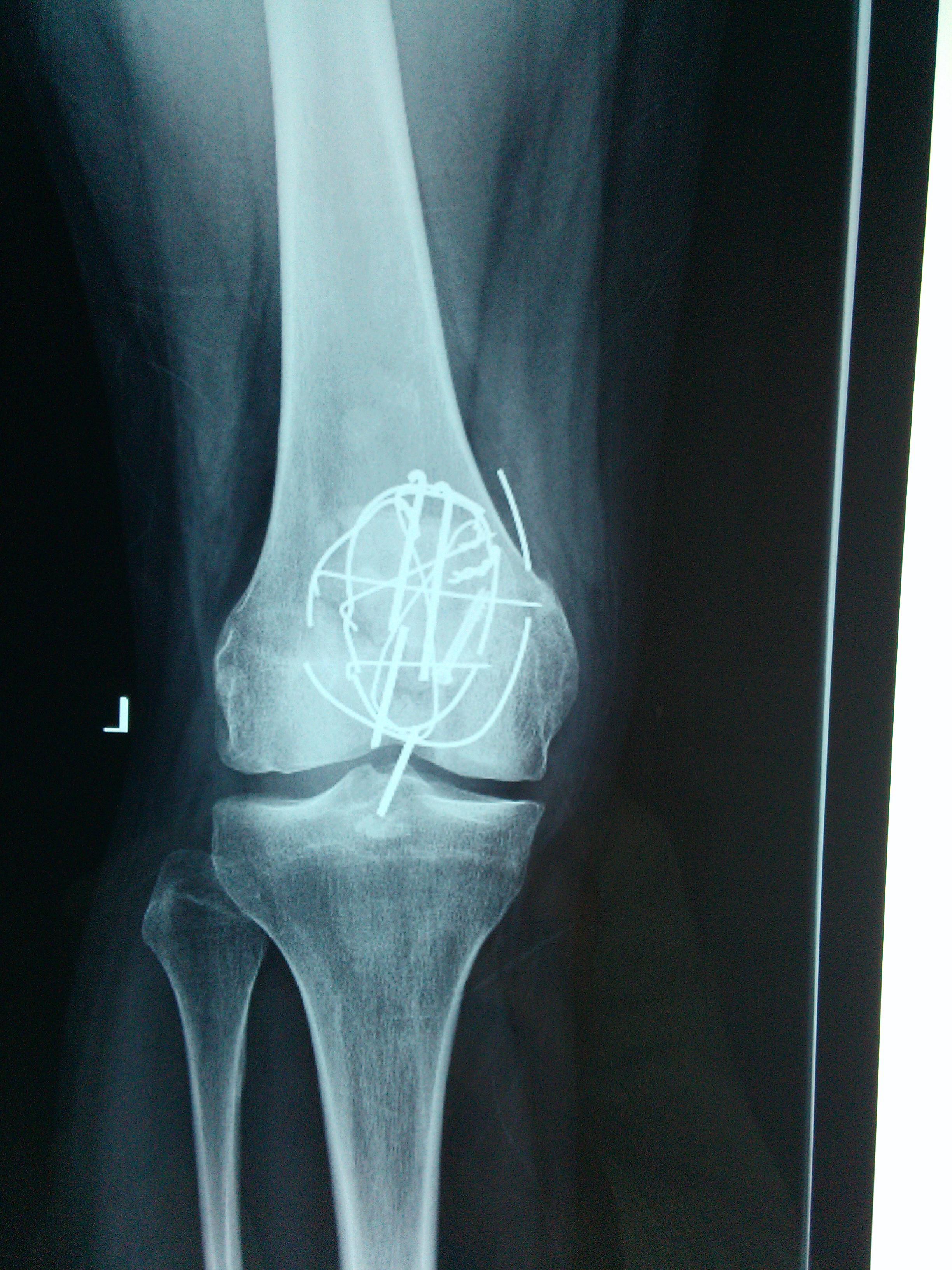 注册x  患者男性,34岁,左髌骨粉碎型骨折术后2年余.