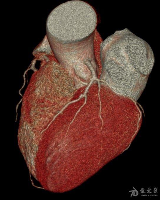 冠状动脉的问题冠脉cta