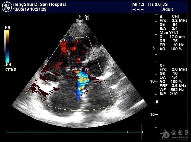 心内膜垫缺损? - 超声医学讨论版 - 爱爱医医学论坛
