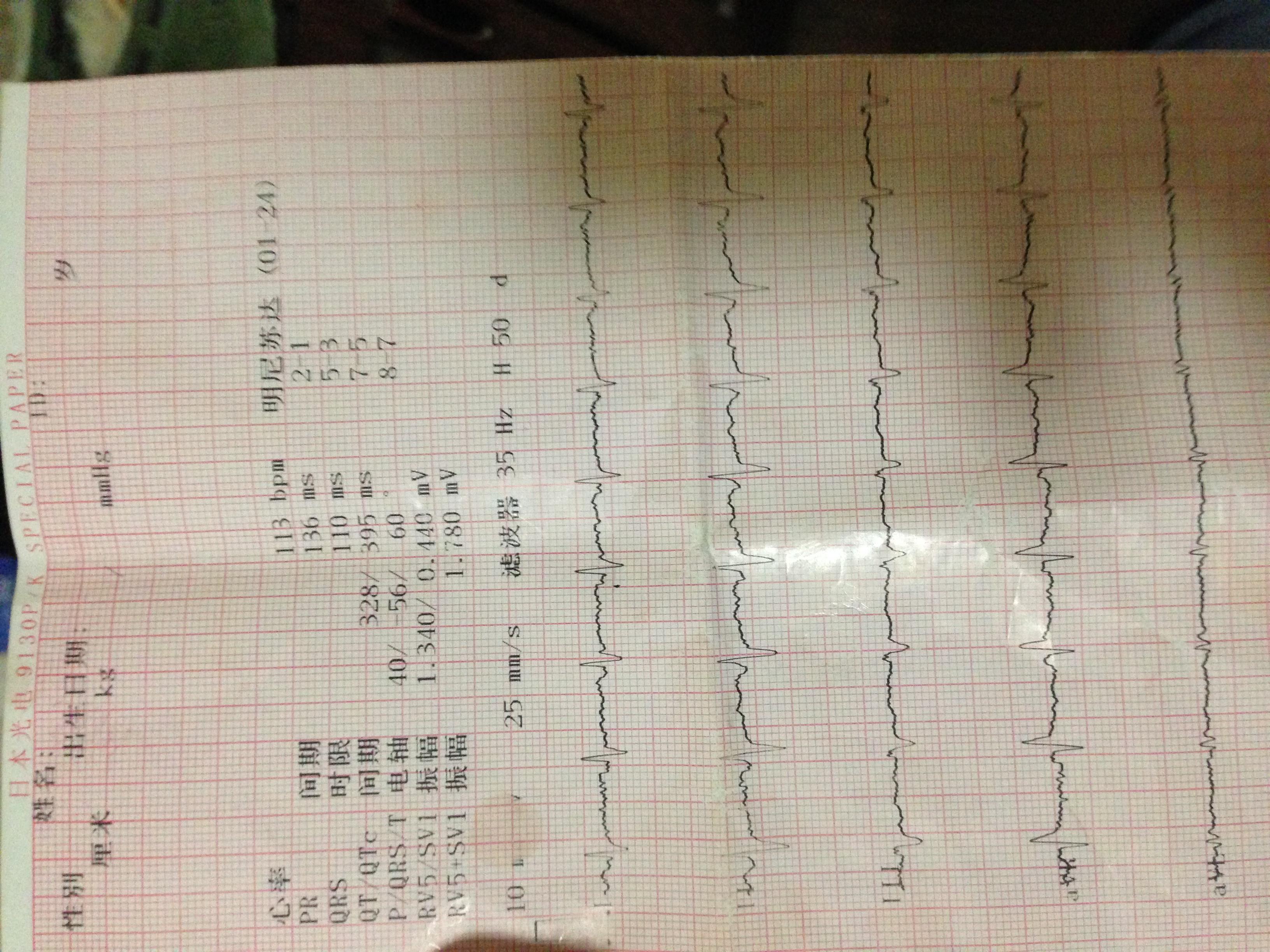 心电图诊断问题