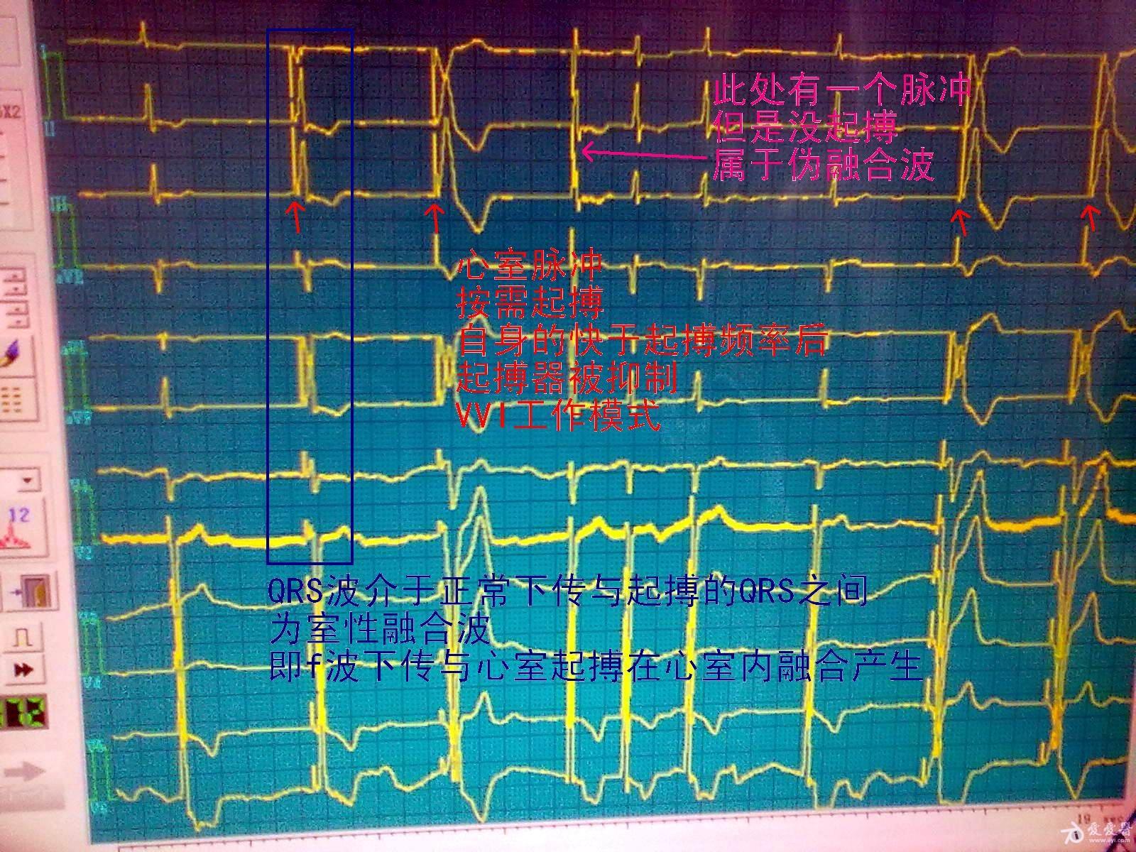 起搏功能正常)  综合诊断:  心房颤动      心室起搏心律(频率60次)