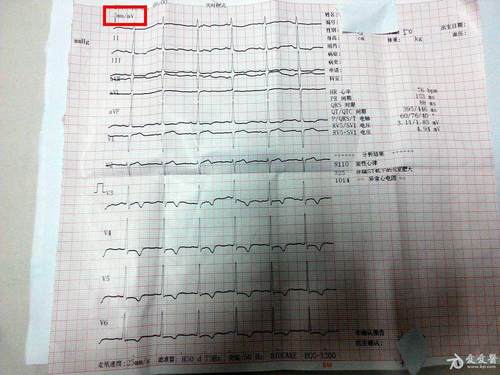老婆今年50岁,体检心电图很严重,有图为证!盼回复