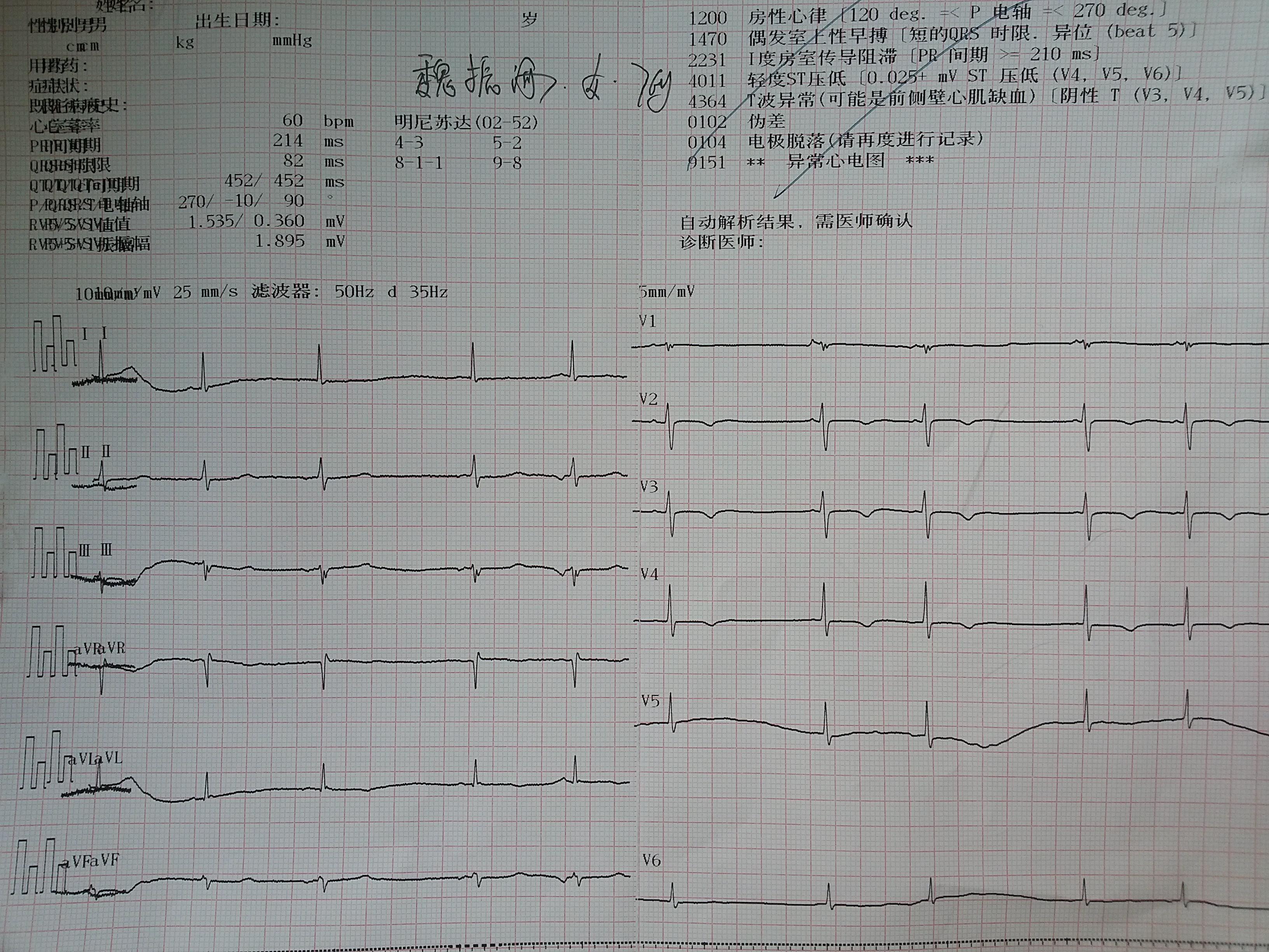 [心电图分析 早博?