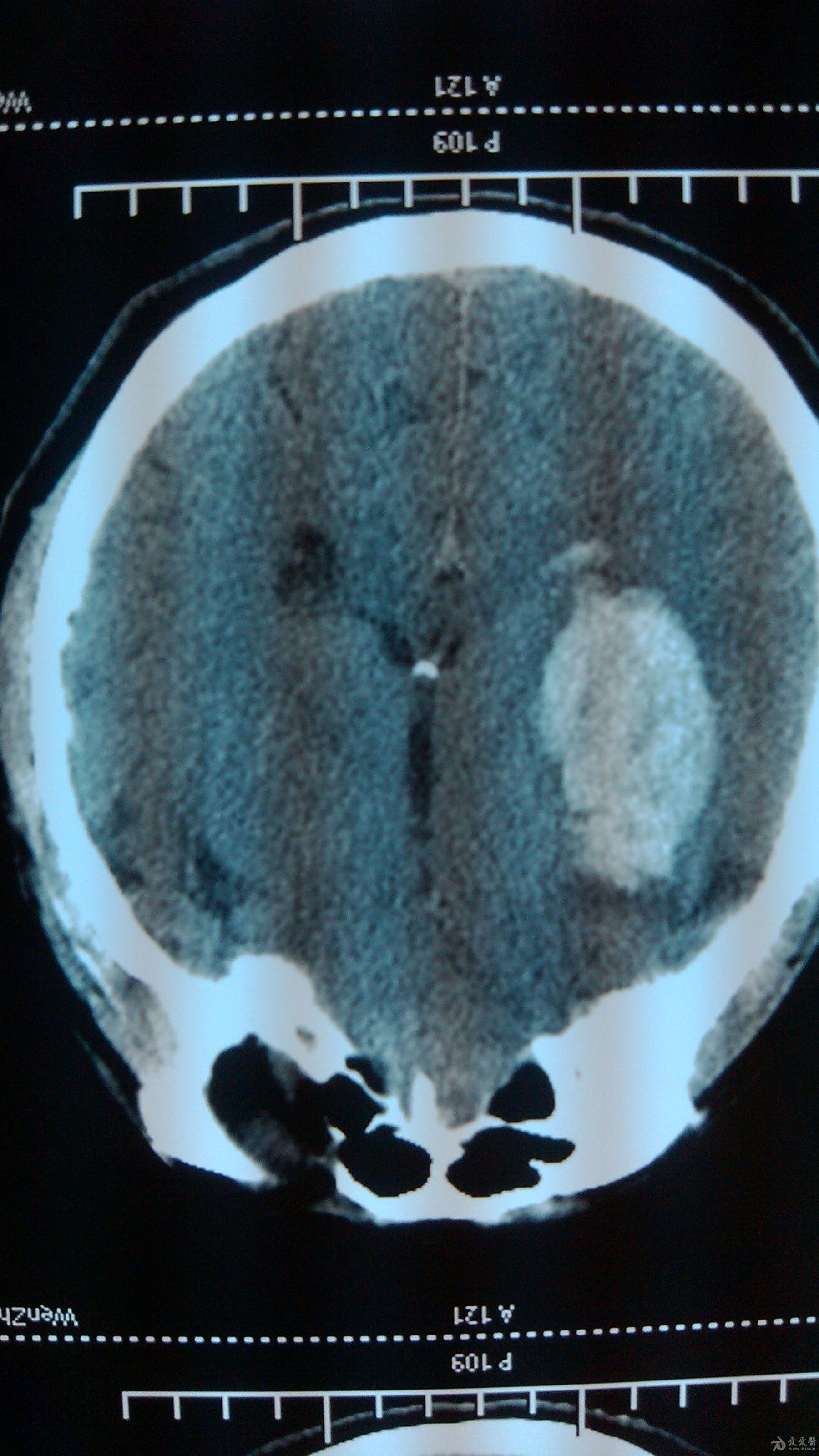 右侧颞叶基底节区侧脑室旁大血肿并破入脑室