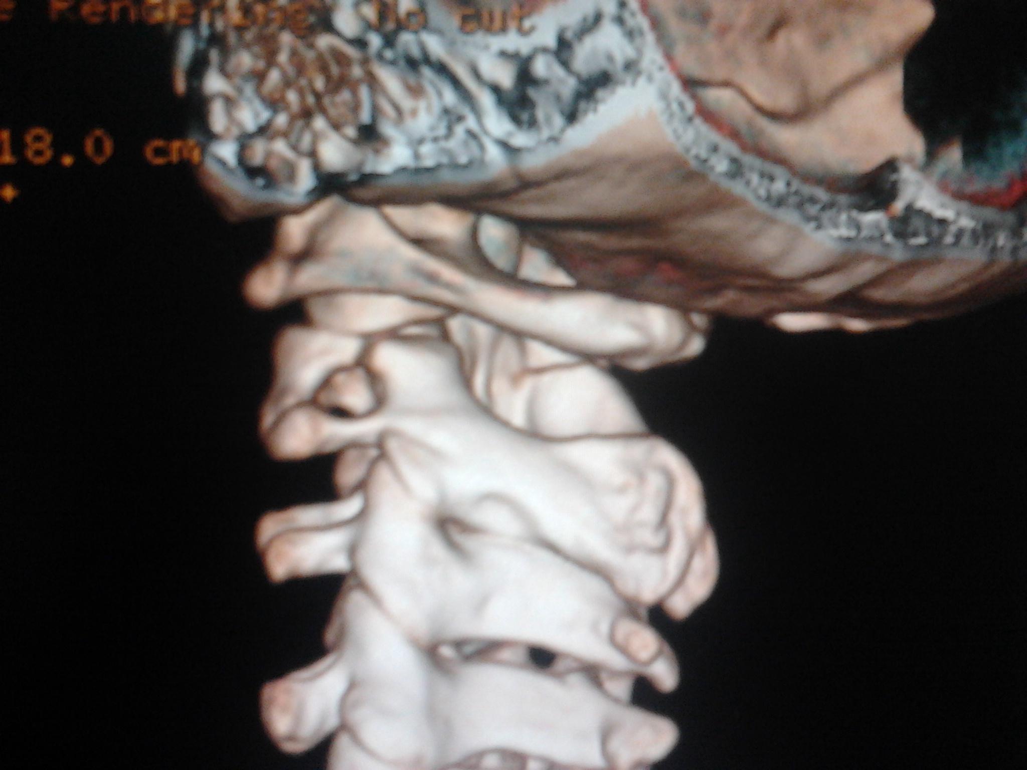 枢椎椎弓根骨折