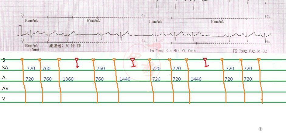 窦房传导阻滞ii度ii型 心电图脑电图专业讨论版 爱爱医医学论坛