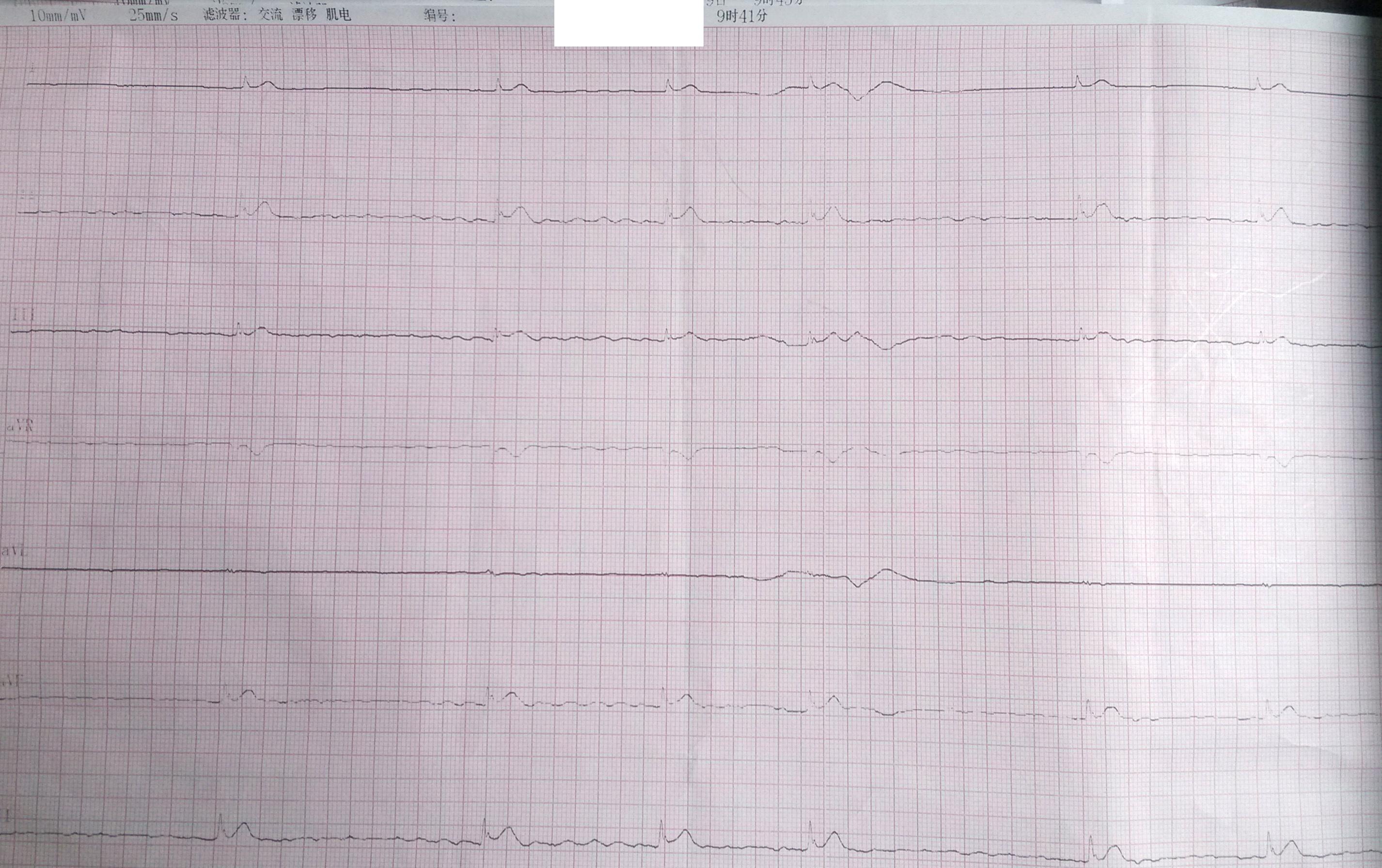 一抢救无效患者心电图