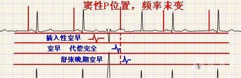 请山羊老师和版主看看,,那两个早搏是什么早搏啊