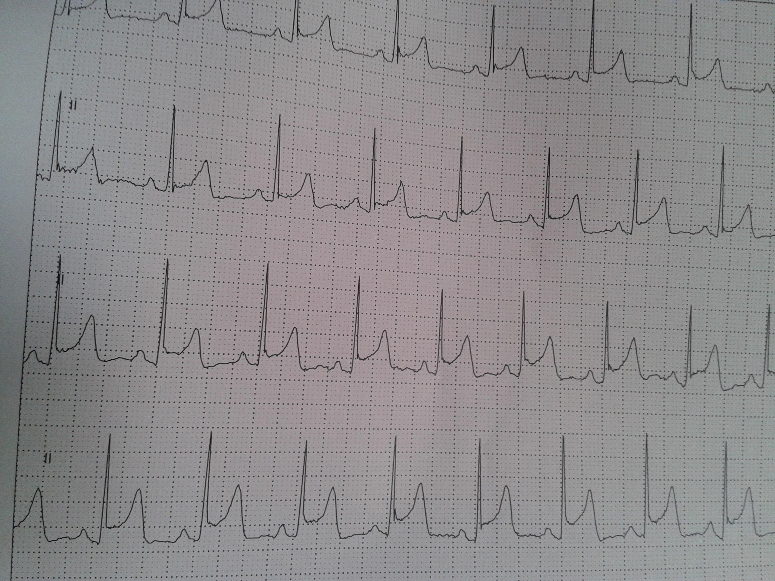 分享一份心绞痛患者心电图的演变过程